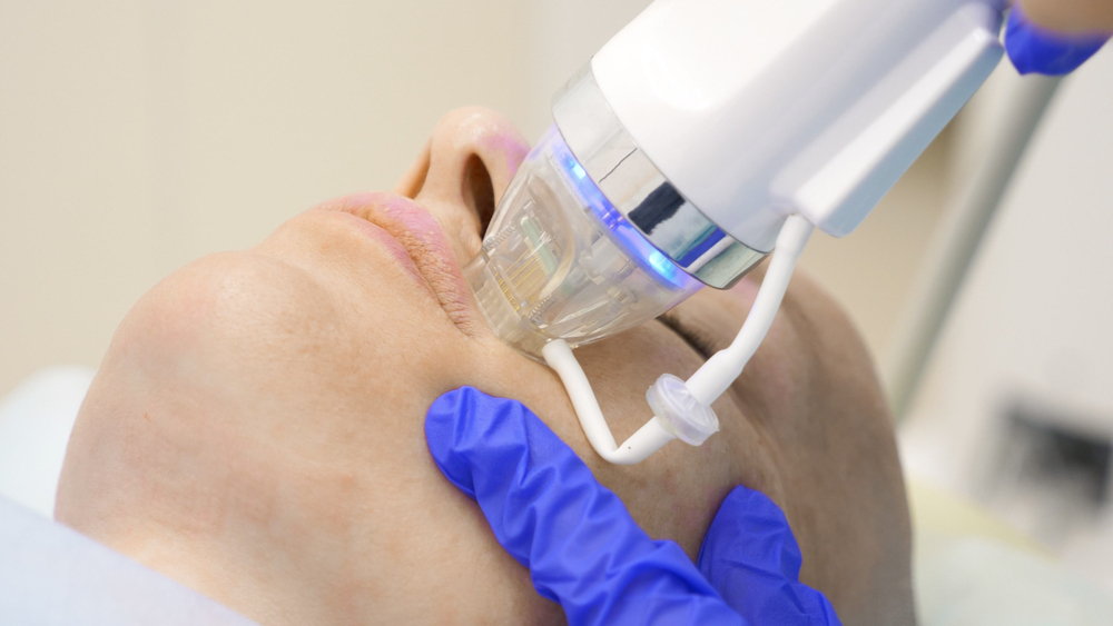 Radio Frequency Microneedling - Saints Aesthetics